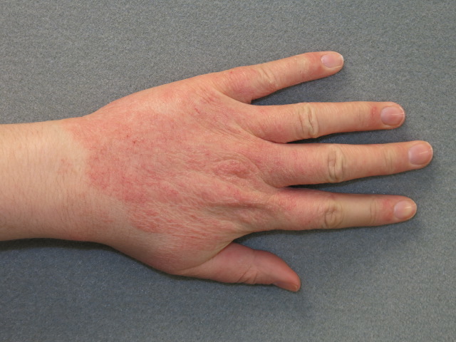 Kontakt dermatitisz vagy ekcéma - Svábhegyi Gyermekgyógyintézet